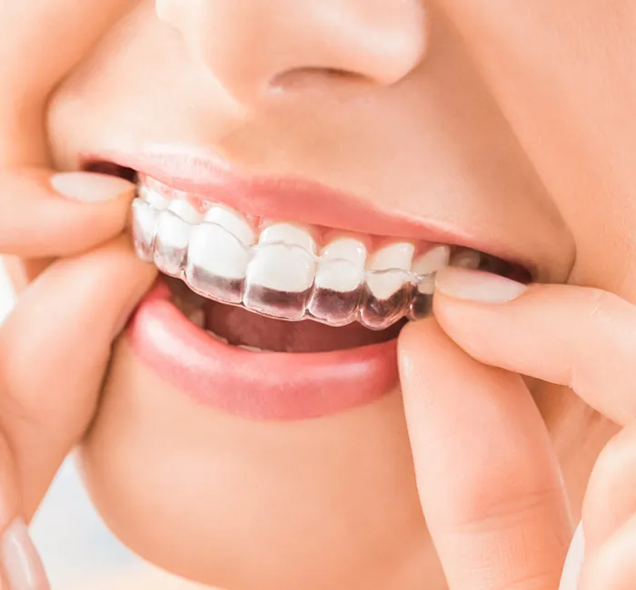 Crooked Teeth