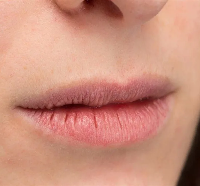 Dry Mouth