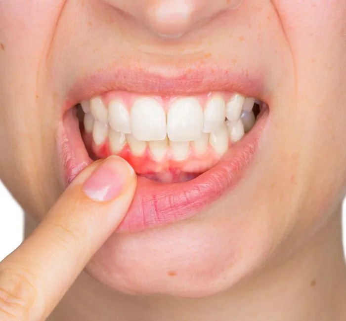 Gum Disease