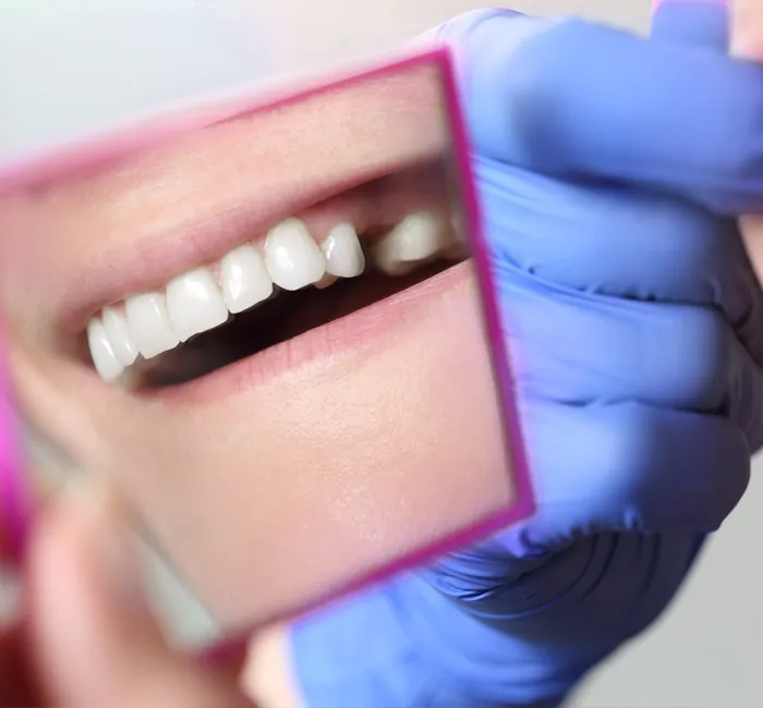 Missing Teeth