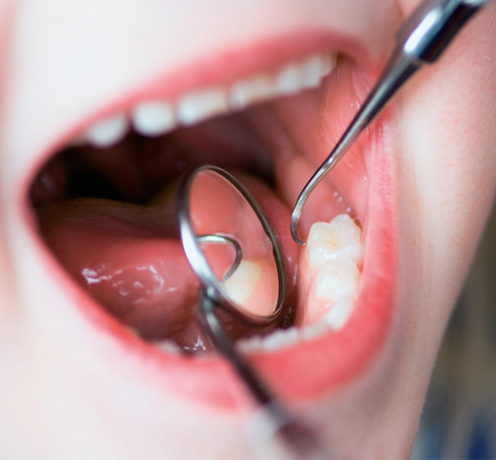 Oral Cancer