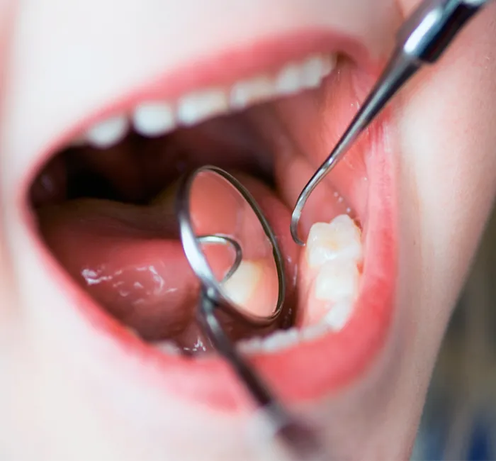 Oral Cancer