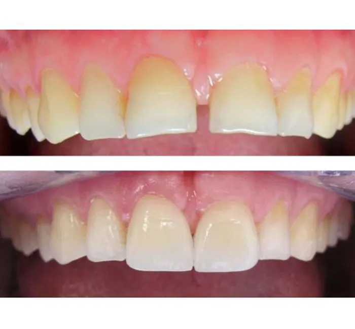 Building Up Worn Teeth