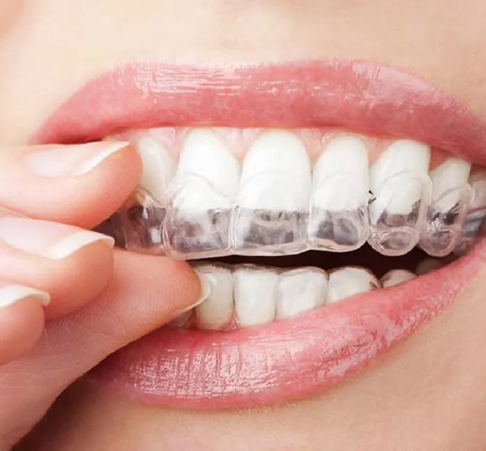 Clear Aligners