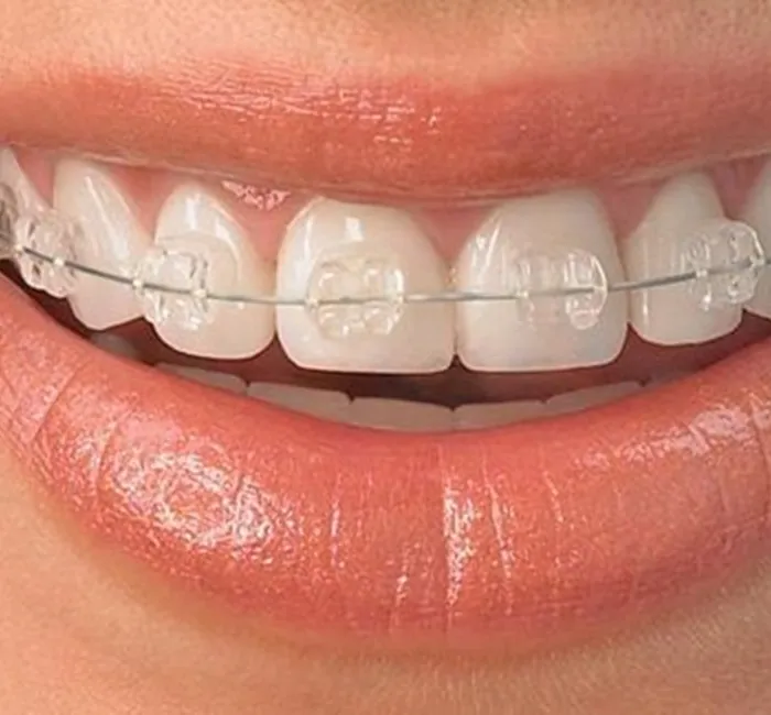 Cosmetic Braces