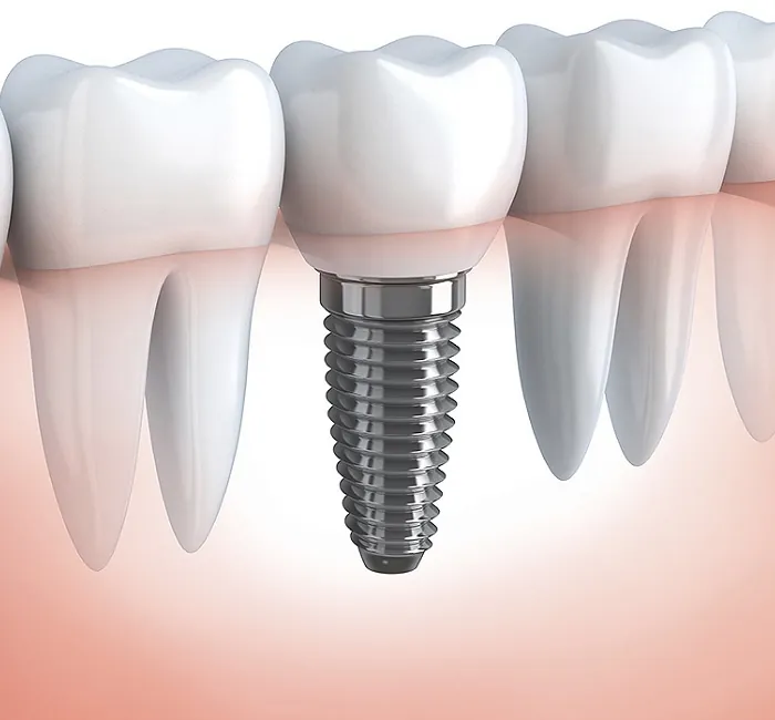 Dental Implants