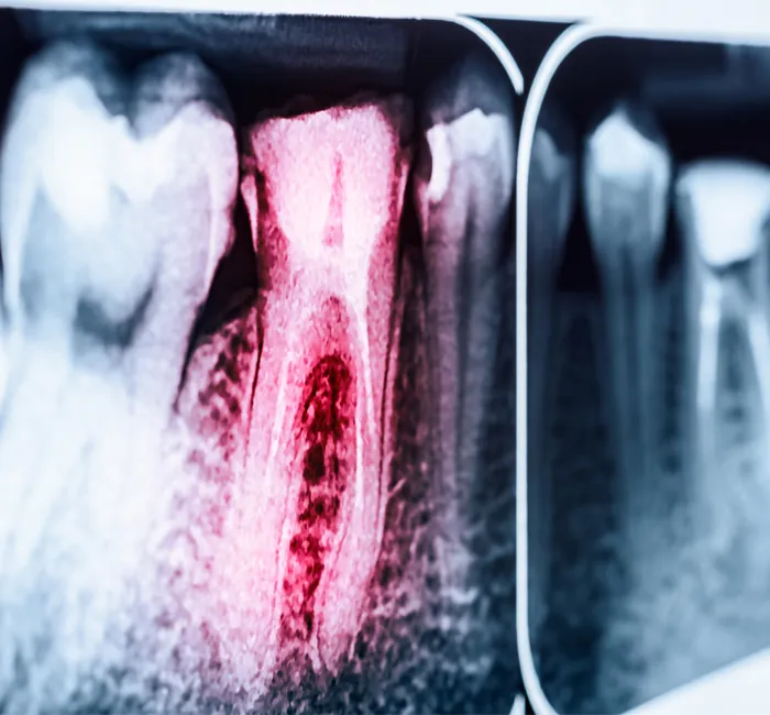 Root Canal Treatment