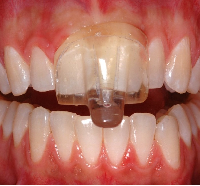 Teeth Grinding Splints