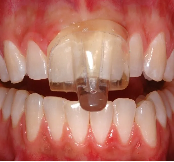 Teeth Grinding Splints