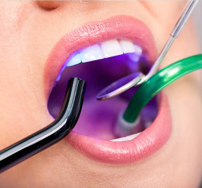 White Fillings